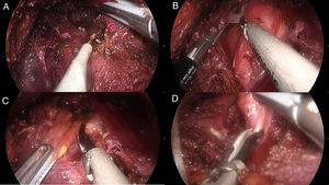 (a) Separation of the thyroid muscles on the midline; (b) Luxation of the thyroid lobe; (c) Division of the isthmus; (d) The superior pole is released.