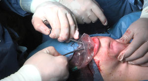 Extraction of the surgical specimen.