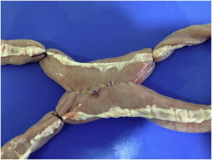 Side-to-side laparoscopic anastomosis with ex vivo cryopreserved viscera.