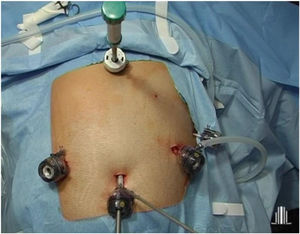 Placement of the trocars in the direct duodenal switch.