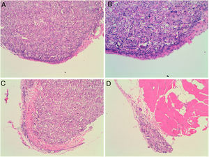 Microscopic findings on the parietal pleura and parietal peritoneum exposed to talc. Group A and B: parietal pleura and hematoxylin and eosin 100× and 200×. Group C and D: parietal peritoneum and hematoxylin and eosin 100× 200×. Signs of injuries, namely inflammation with foreign body granulomatous reaction (talc crystals), mesothelial proliferation and fibrosis, were observed in the pleural and peritoneal mesothelium.