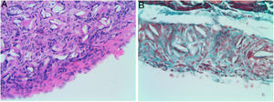 Microscopic findings on the parietal pleura and parietal peritoneum after being exposed to talc. Group A: parietal pleura and hematoxylin and eosin × 400; Group B: parietal peritoneum and Masson's trichrome × 400. Multinucleated foreign body giant cells containing birefringent talc crystals with granulomas formation were observed in the submesothelium.