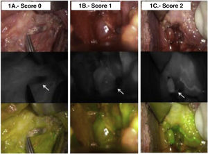 Intraoperative ICG angiographic images, showing examples of parathyroid glands well vascularized (white, viability score 2), partially vascularized (gray/heterogeneous, viability score 1), and devascularized (black, vitality score 0).