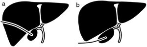 Diagram of the PC techniques: (A) PC with a transhepatic approach; (B) PC with a transperitoneal approach.