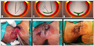 Intraoperative wound after TROPIS (transanal opening of intersphincteric space). Schematic diagram: Panel-A: Intersphincteric tract (green colour) and an artery forceps inside the internal opening about to be laid open with electrocautery. Panel-B: Intersphincteric tract laid open with electrocautery. Panel-C: Intersphincteric space distal (inferior) to the internal opening laid open by a vertical incision. Intraoperative photograph: Panel-D: A curved artery-forceps inside the intersphincteric tract before laying it open. Panel-E: TROPIS wound in the anal canal. Panel-F: The tube inserted in the high abscess cavity and sutured to the skin with monofilament non-absorbable suture (2–0 nylon).