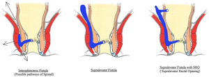 Pathways of spread of Intersphincteric anal fistula. Left panel: Intersphincteric fistula. Middle panel: Supralevator fistula. Right panel: Supralevator fistula with additional supralevator rectal opening (SRO).
