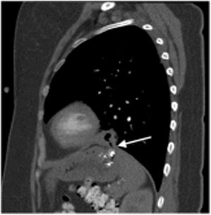 Sagittal CT scan: The gastric fundus is seen to be adhered to the left hemidiaphragm, and an air bubble (arrow) is observed moving towards the pleural cavity near the LLL. LLL: left lower lobe; CT: computed tomography.