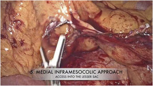 Release of the splenic flexure with a laparoscopic inframesocolic medial approach.