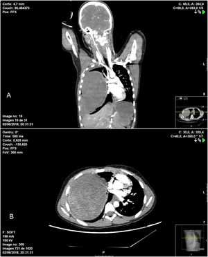 Chest CT showing heterogenous intrapulmonary mass associated with moderate hemothorax occupying practically the entire right hemithorax, causing significant mass effect, with complete collapse of the ipsilateral pulmonary vessels in addition to displaced mediastinal structures: A) coronal image; B) axial image.