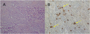 A) H-E: proliferation of fibroblasts with no signs of malignant disease and chronic inflammation, interspersed with a predominance of plasma cells; B) Immunohistochemistry: positive plasma cells for IgG4 (yellow arrows).