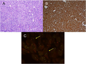 A) H-E: fibrohistiocytic cell proliferation, which is organized in short or storiform fascicles, accompanied by prominent inflammatory infiltrate. No necrosis or vascular permeation is observed; B) IHC: immunohistochemistry stain positive for ALK; C) FISH: translocation for ALK gene (yellow arrows).