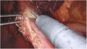 Oesophageal myotomy with preservation of the submucosal plane.