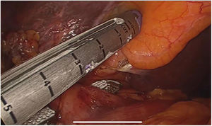 Cholecystoduodenal fistula section (Mirizzi’s syndrome type 5a) with mechanical suture.