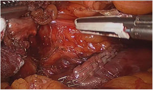Duodenal border following section of cholecystoduodenal fistula (Mirizzi syndrome type 5a) with mechanical suture.