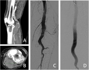 Case 1. A: popliteal aneurysm reconstruction. B: lower limb CT angiography with cross section with measurement of popliteal aneurysm. C: intraoperative arteriography. D: arteriography with implanted graft, showing exclusion of the popliteal aneurysm and distal patency to it.