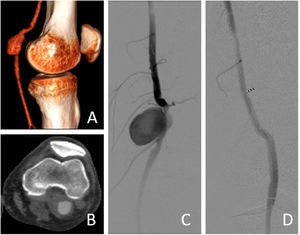 Case 2. A: 3D reconstruction of saccular popliteal aneurysm. B: Angio-CT cross section. C: intraoperative arteriography. D: arteriography after graft implantation, showing popliteal aneurysm exclusion and distal patency.