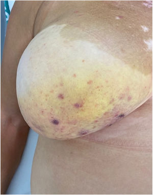 Angiosarcoma of the right breast prior to systemic treatment.