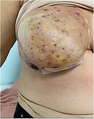 Disease progression after 3 months of systemic treatment.