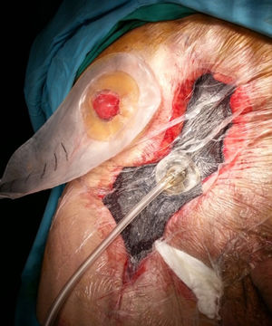 Negative pressure therapy applied to the mid laparotomy incision after postoperative infectious complication of parasternal prosthetic hernia repair. Wound closure by secondary intention.