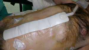Prophylactic incisional negative pressure therapy after anterior component separation surgery.