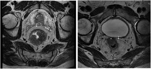 Axial MRI slices. On the left, tumour of the rectum located on the left lateral aspect (T2MR). On the right, tumour invading the serosal surface (area marked with an asterisk) at the anterior level (T4aMR). The arrows show the peritoneal reflection.