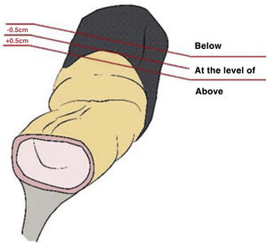 Diagram of the surgical specimen showing the serosal surface in orange and the mesorectal fat in black, with the references to classify the tumours with respect to the PR.
