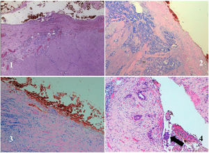 Grades of peritoneal serous involvement described by Shepherd in 1995. Grade 1: free of involvement; grade 2: close with involvement due to inflammation; grade 3: involvement of visceral serosa; grade 4: serosal ulceration with peritoneal micro-implants.
