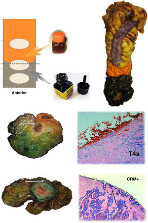 Protocol for staining the surgical specimen. The mesorectal fat is stained with India ink and the serosal surface with orange dye. In the lower part, axial sections of 2 different surgical specimens and histological sections showing involvement of the resection border at the level of the orange dye (T4a) and the India ink (CRM involvement). The arrows point to the tumour front in both macroscopic and microscopic sections.