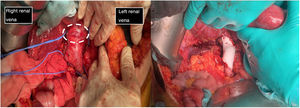 The first image shows the moment when structures were identified prior to excision of the leiomyosarcoma. It depicts the vascular control in the retrohepatic and infrarenal cava and both renal veins prior to tumour removal (tumour marked with white dashed line). The second image shows the presence of a PTFE prosthesis to replace the IVC, both renal veins have been preserved, reinserting the left one.