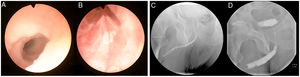 Cystoscopy showing urethral stenosis with involvement from distal urethra (A) to verumontanum (B). Retrograde urethrography with panurethral stenosis, image preoperative (C), and 3 months after surgery (D).