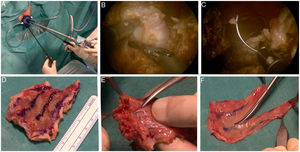 Removal of rectal mucosal graft by transanal minimally invasive surgery (TAMIS) with GelPOINT® platform (A). Dissection down to the circular stratum of the tunica muscularis (B) and closure with V-Loc™ 3-0 longitudinal barbed suture (C). Rectal patch removed (D), separation of the rectal mucosa (E) and carving of the rectal mucosa in an “N” shape resulting in a free longitudinal graft of 22 × 1.5 cm (F).