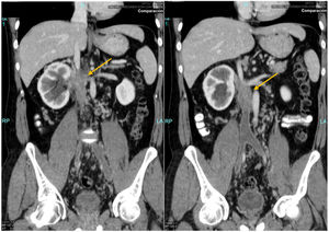 Preoperative CT scan: coronal slices. Showing tumour affecting the IVC and right RV and complete thrombosis of the common iliac veins and IVC up to the infrarenal level.