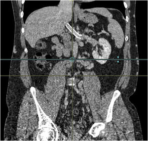 CT scan four years after the surgery. Coronal slice. No signs of recurrence. Permeable vascular prosthesis is observed.