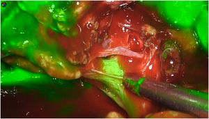 Identification of the bile duct.