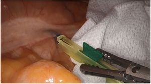 Intraoperative injection of ICG in cecum tumour.