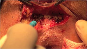 Deep dissection of the anovaginal space.