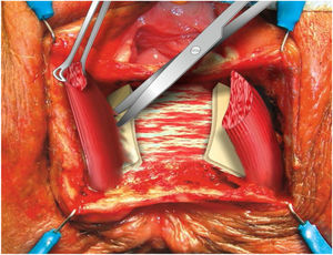 Dissection of the intersphincteric space.