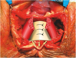Sphincterorrhaphy of the internal anal sphincter.