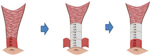 Comparative scheme between the classical technique and the anatomical sphincteroplasty.