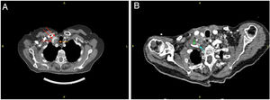 Preoperative (A) and postoperative cervical CT scan after reconstruction of the lesion (B). Red arrow: carotid pathway; orange arrow: lymphadenopathy; blue arrow: PTFe prosthesis; green arrow: patent subclavian artery distal to the by-pass.