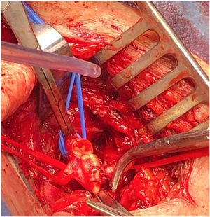 Intraoperative view of the lesion at the level of the proximal subclavian artery, marked with blue vessel-loop; carotid artery marked with red vessel-loop.
