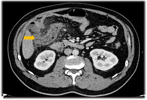 Diverticulitis in right and transverse colon, with mural thickening.
