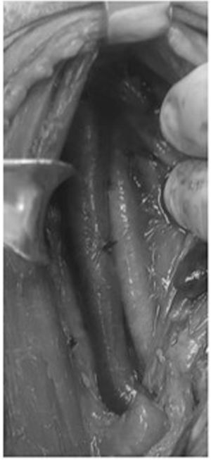 Operative neck exploration due to a penetrating injury.