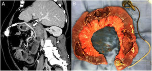 (A) CT scan of the abdomen and pelvis showing the gastric tube within the intestinal lumen (straight arrow). (B) Four long perforations at the proximal jejunum.