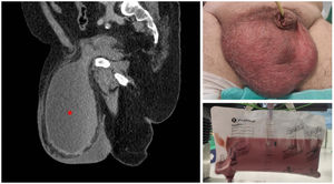 Pyocyst in giant inguino-scrotal hernia containing the urinary bladder.