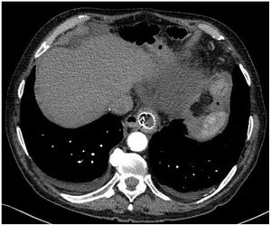 CT image of the re-admission: axial slice showing the oesophagus containing the endoprosthesis in the lower thorax, with no active bleeding.