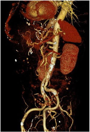3D angio-CT reconstruction showing the proximity of the endoprosthesis and the aortic wall.