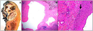 (A) Right hepatectomy specimen with identification of a multicystic lesion with cavities between .3–4 cm in diameter with abundant haematic content inside, located immediately proximal to the right SHV. (B) Multiple cysts lined with cylindrical or cuboidal biliary epithelium without atypia, with areas of haemorrhage at the periphery. H&E staining. 10× magnification. (C) Cysts lined by cuboidal biliary epithelium without atypia and interposed liver tissue (arrow). No ovarian-type stroma is observed in the lamina propria of any of the cysts. H&E staining. 10× magnification.