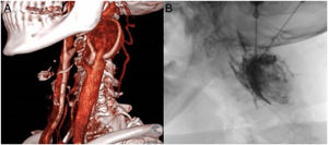 (a) 3D angio-CT reconstruction showing hypervascularised tumour in the left carotid bifurcation. (b) Embolisation by direct puncture with Onyx®.