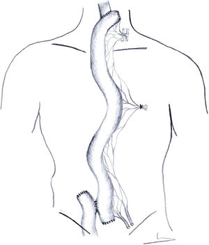Superchargedjejunoplasty.